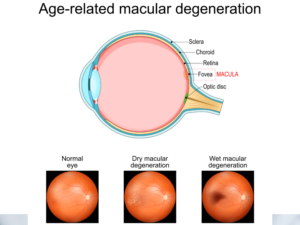 crystal-clear-opticians-macular-degeneration Eye exam